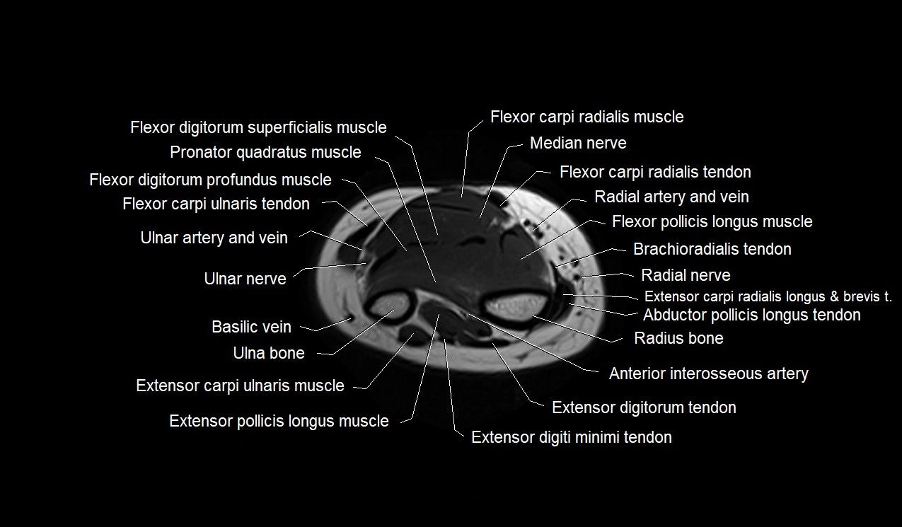 MRI 3T forearm axial cross sectional anatomy image 40.webp